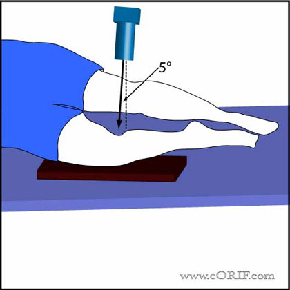 lateral knee xray technique