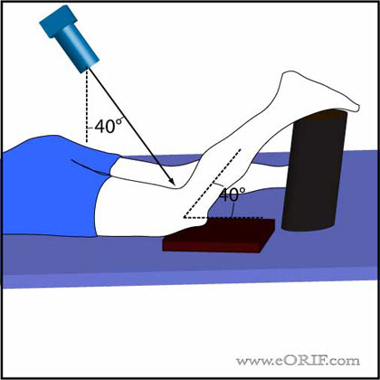 Intercondylar notch view technique