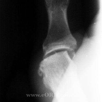 MCP arthritis xray Thumb MCP osteoarthritis xray