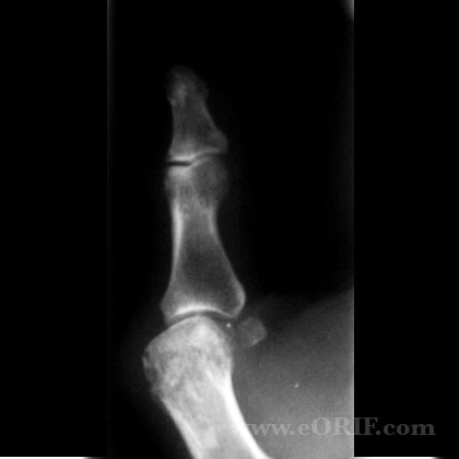 MCP arthritis xray MCP osteoarthritis xray