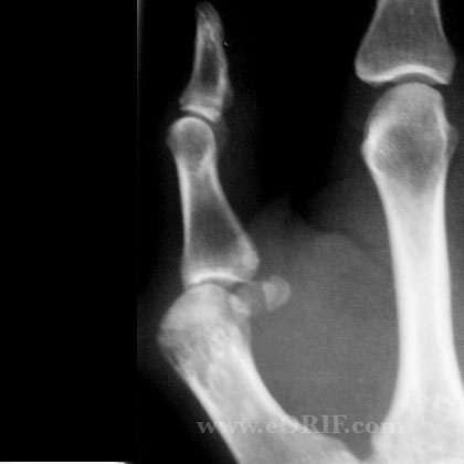 MCP arthritis lateral view MCP arthritis lateral view xray