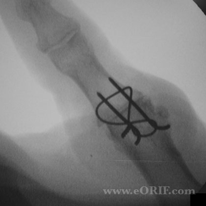 MCP arthritis xray Thumb MCP arthrodesis xray