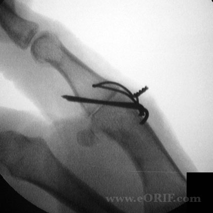 Thumb MCP arthrodesis Thumb MCP arthrodesis