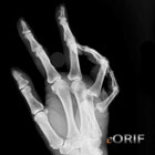 MCP-dislocation MCP-dislocation