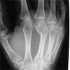 Metacarpal neck fracture xray