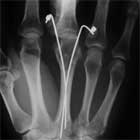 CRPP metacarpal neck fracture xray