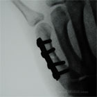 Metacarpal shaft fracture ORIF xray