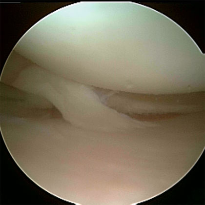 Flap Meniscal Tear  picture