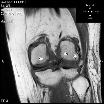 Bucket handle meniscal tear MRI