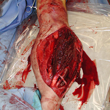 Grade 3 open tibial shaft fracture image