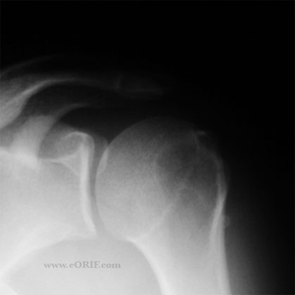 Os Acromionale xray