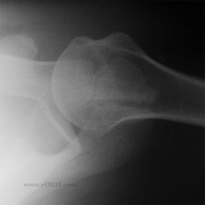 Os acromionale xray