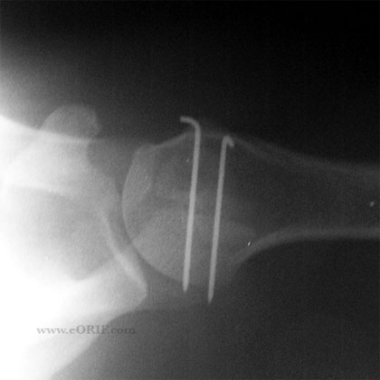 Os Acromionale ORIF xray