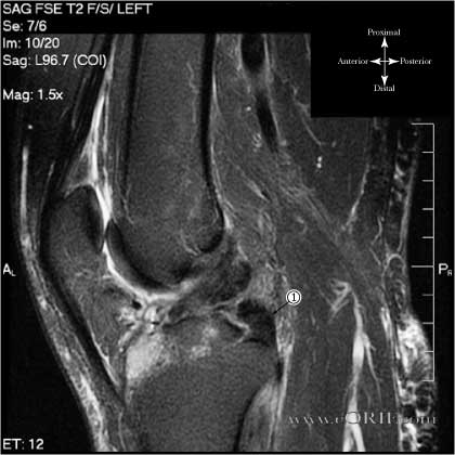 PCL Tear MRI image