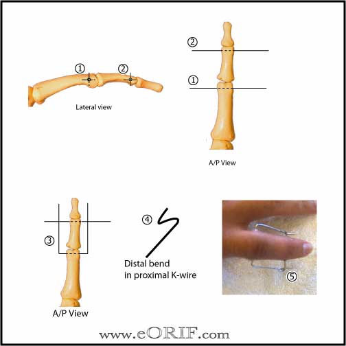 PIP joint external fixation PIP joint external fixation technique