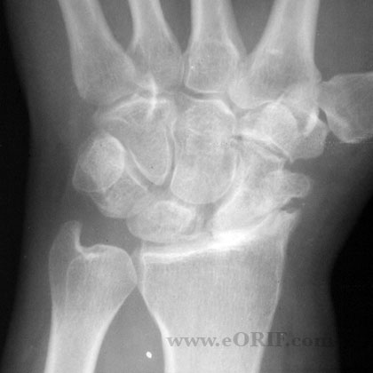 Wrist arthritis Wrist arthritis xray
