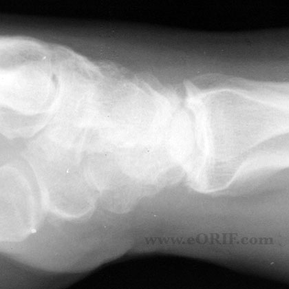 Wrist arthritis lateral xray Wrist arthritis lateral view xray