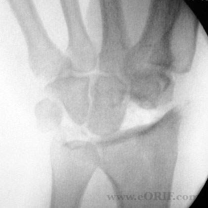 Proximal row carpectomy Proximal row carpectomy xray