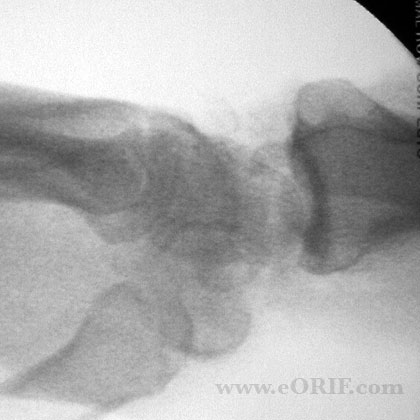 Proximal row carpectomy Proximal row carpectomy lateral view