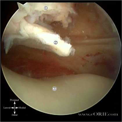 patellar dislocation picture