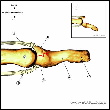bony mallet finger boney mallet finger
