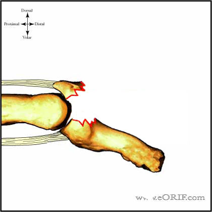 distal phalanx mallet fracture distal plalanx mallet fracture