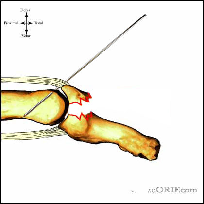 CRPP bony mallet CRPP bony mallet