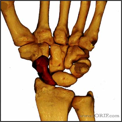 Preiser's disease Preisers disease image