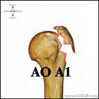 Greater tuberosity fracture classification