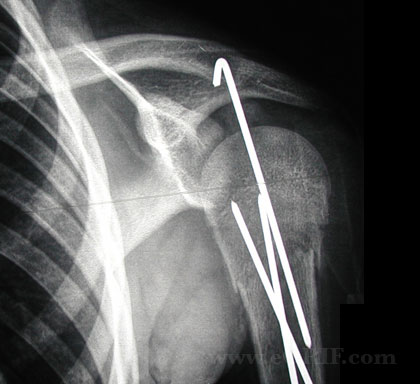 Pediatric proximal humerus fracture CRPP xray