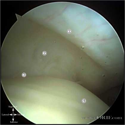 rotator cable arthrscopic picture