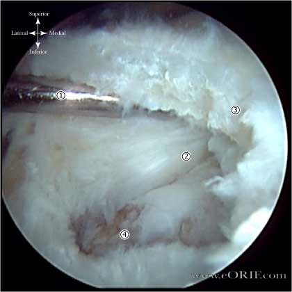 rotator cuff tear arthroscopic view