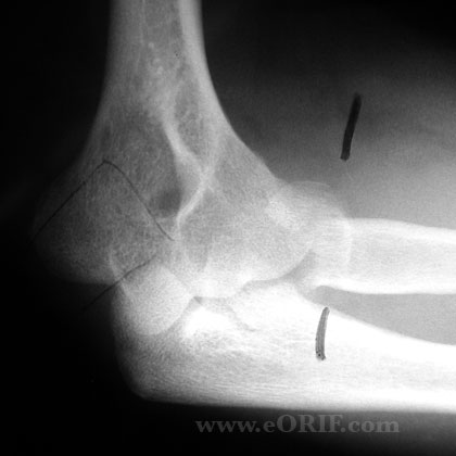 Type III Radial head fracture xray