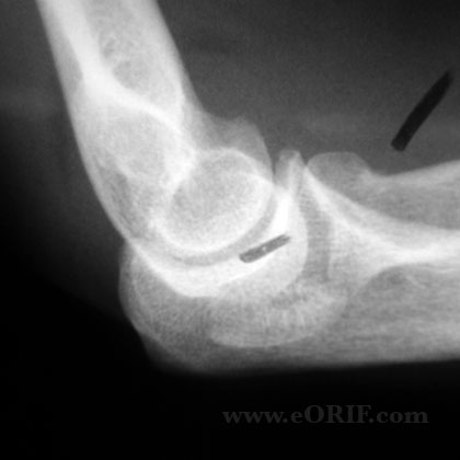 Radial Head Fracture