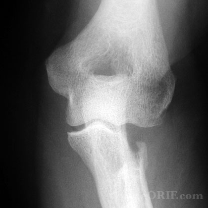 Radial head excision xray