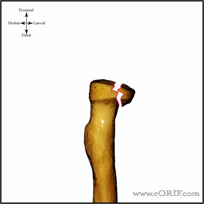 type II radial head fracture image