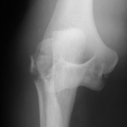 Mason Type IV radial head fracture xray Mason Type IV radial head fracture xray