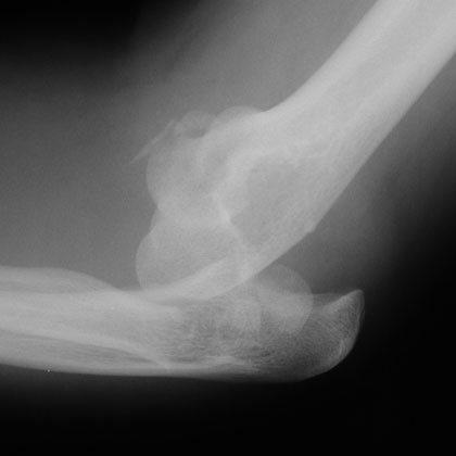 Mason Type IV radial head fracture xray Mason Type IV radial head fracture xray