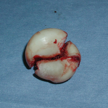 radial head fracture comminution radial head fracture fragments