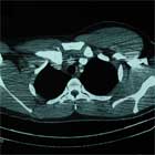 Sternoclavicular Dislocation CT