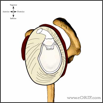 Type III SLAP Tear