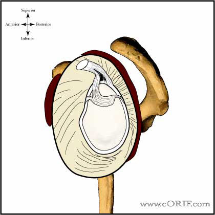 Type IV SLAP Tear