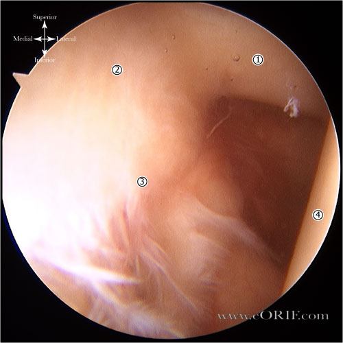 Type I SLAP tear arthroscopic image