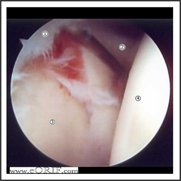 Type II SLAP Tear arthroscopic image