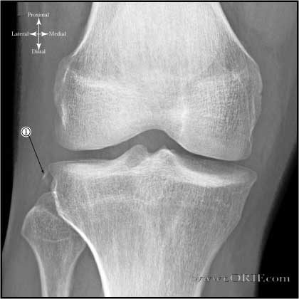 Segond Fracture image segond fracture image