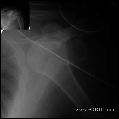  Anterior Inferior Shoulder Dislocation 