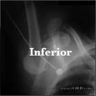 Inferior shoulder dislocation