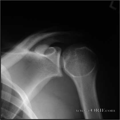 Posterior Shoulder Dislocation picture