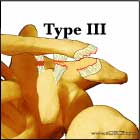 Type III AC joint separation