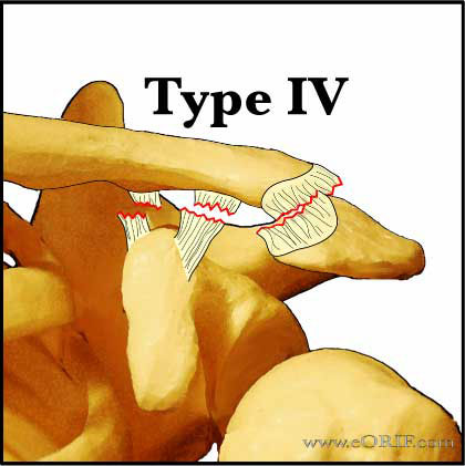 Type 4 AC separation